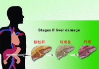 脂肪肝能吃肉吗？得了脂肪肝可不可以吃肉？